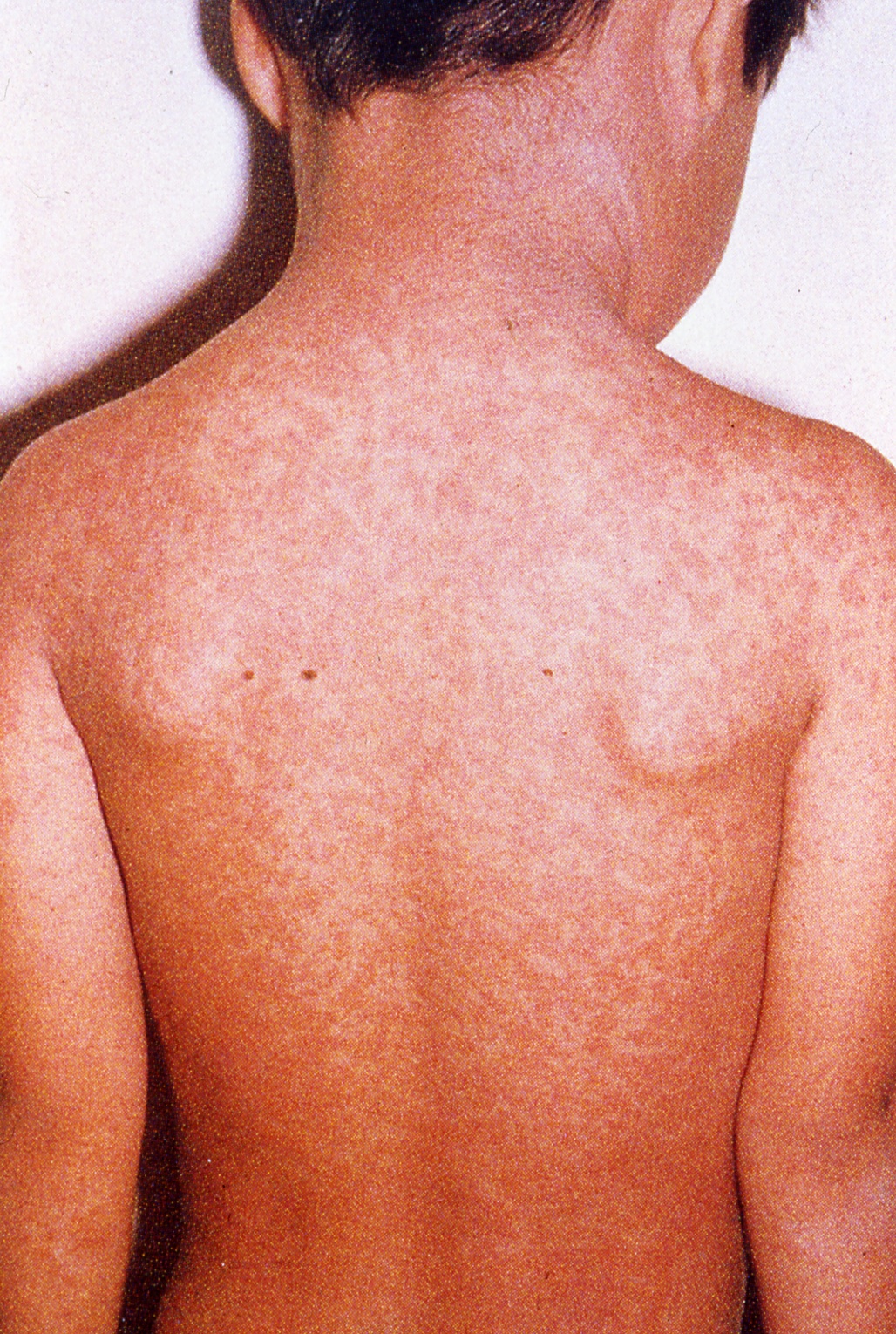 丘疹性荨麻疹与虫咬皮炎 - 知乎